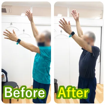 70代男性A様のビフォーアフター写真。左腕が頭の高さまで上がるように改善